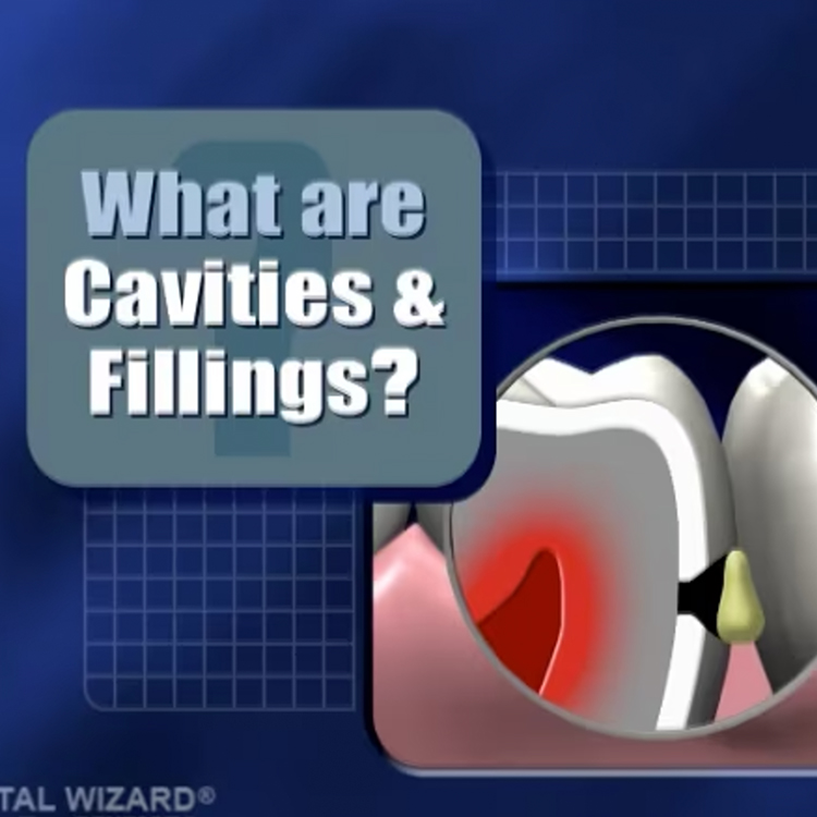 What are Cavities & Fillings?
