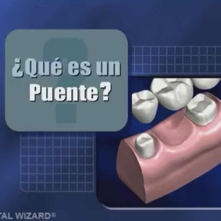 What is a Bridge? (Spanish)