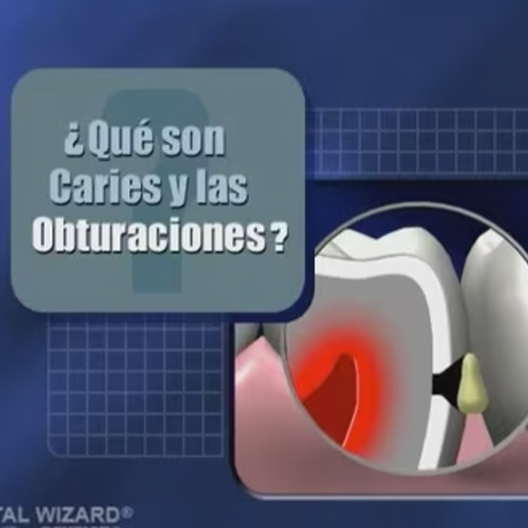What are Cavities & Fillings? (Spanish)