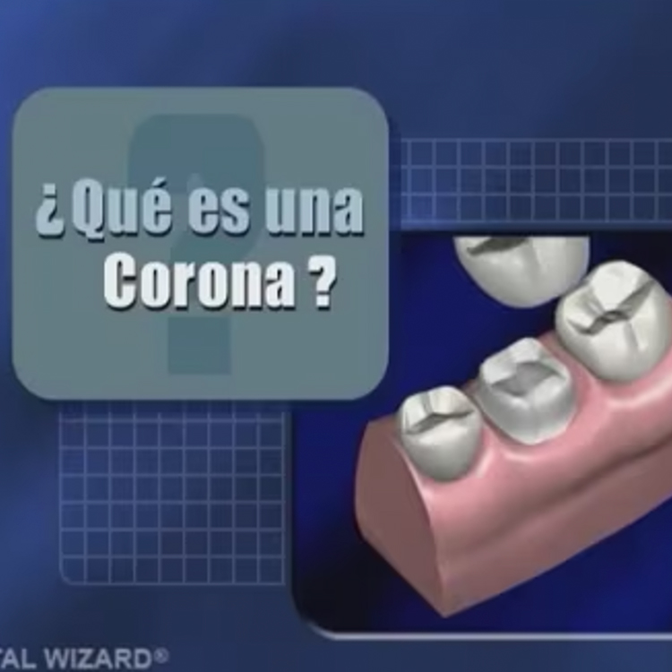What is a Dental Crown? (Spanish)